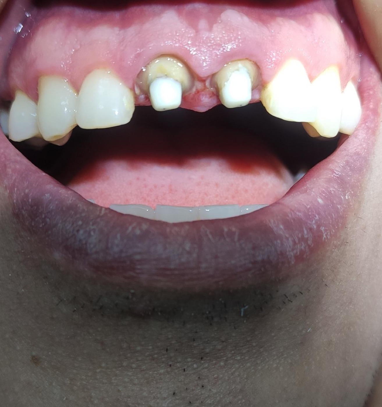 Antes de coronas dentales