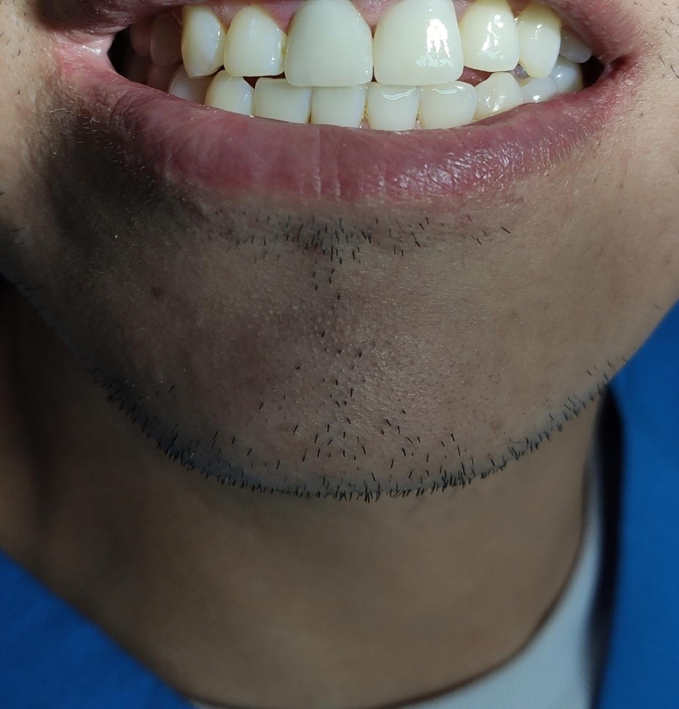 Después de coronas dentales